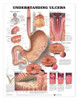 Understanding Ulcers Laminated Anatomical Chart