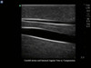 Gen II Ultrasound Central Line Training Model Replacement Tissue Insert