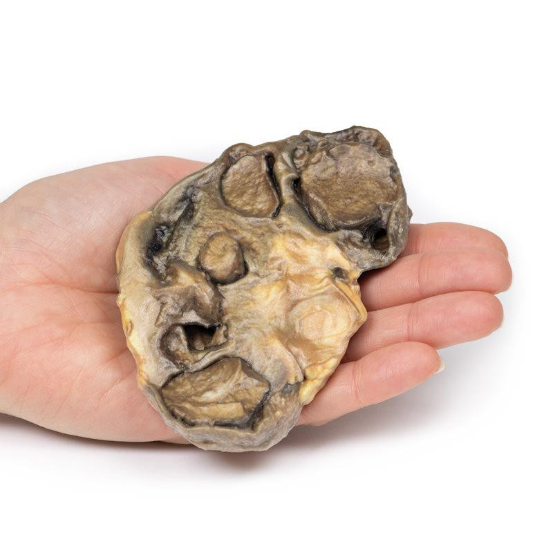 3D Printed Pyonephrosis - Anatomy Warehouse