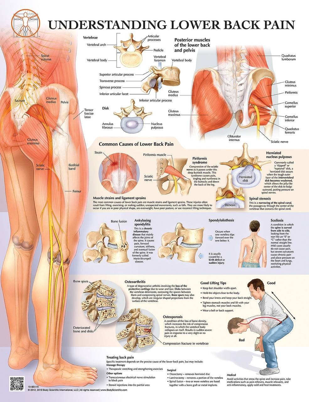 Lower Back Pain Laminated Wall Chart With Digital Download Code