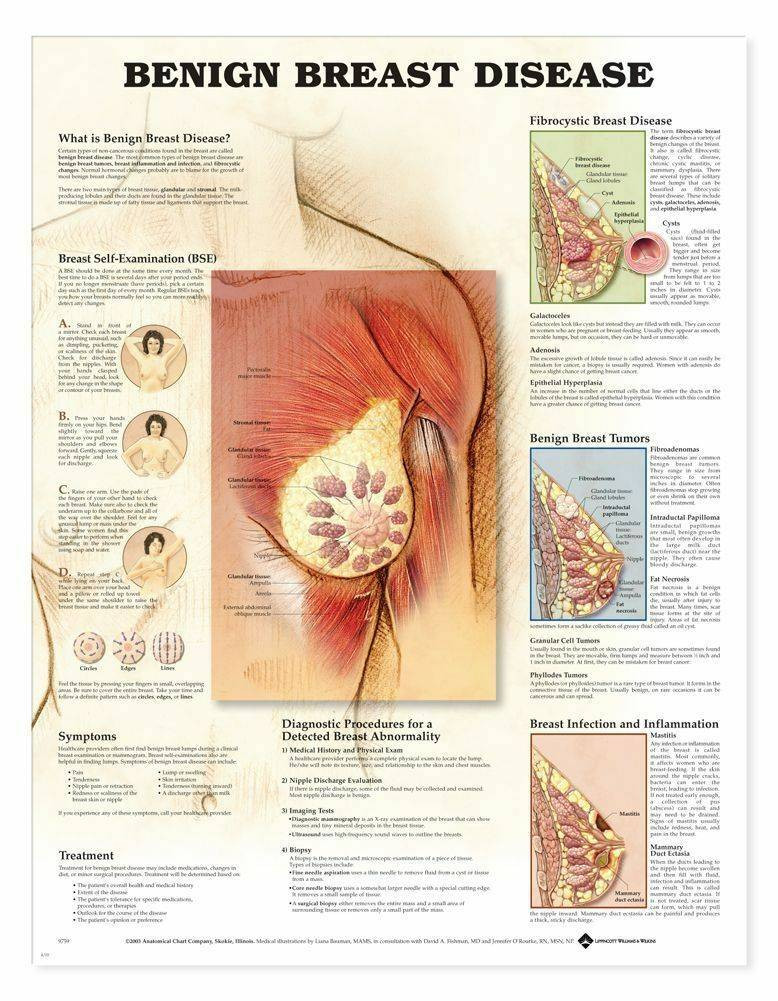 https://cdn11.bigcommerce.com/s-pimv2ff7eu/images/stencil/1280x1280/products/4630/19660/anatomical-chart-company-benign-breast-disease-laminated-anatomical-chart__25808.1606469984.jpg?c=1&utm_source=chatgpt.com