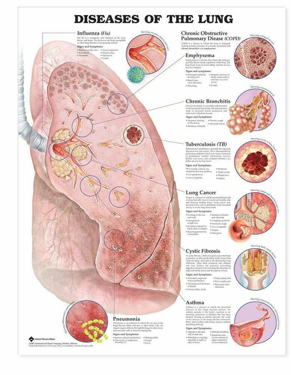 cystic fibrosis lungs diagram