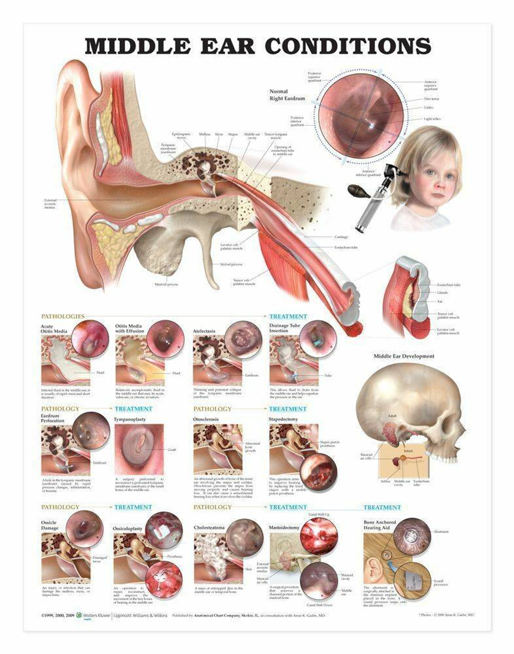 Stapedectomy of the Stapes of the Ear - Labelled – Medical Stock