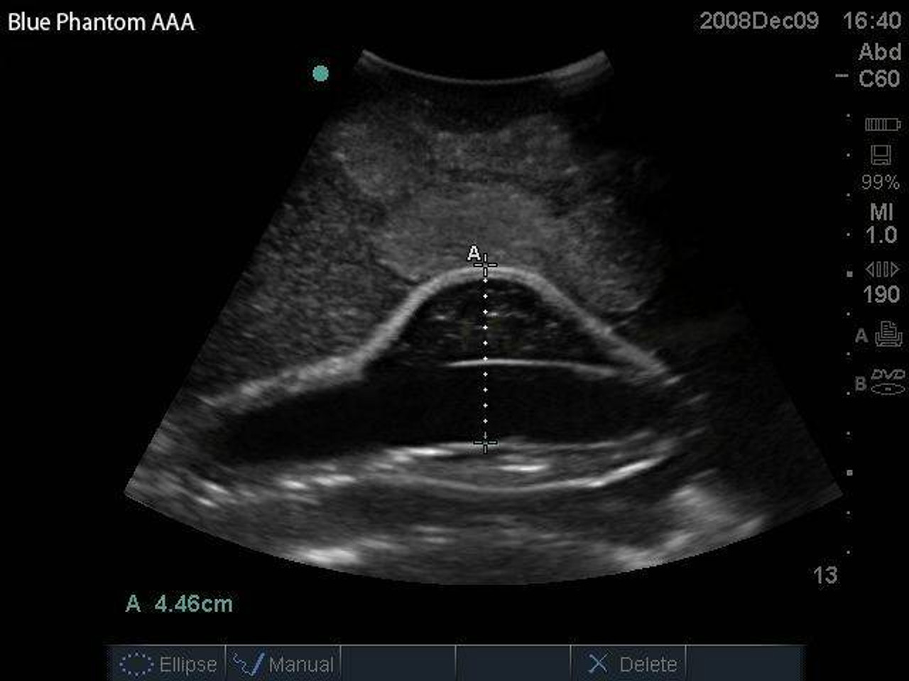 abdominal aortic aneurysm ultrasound