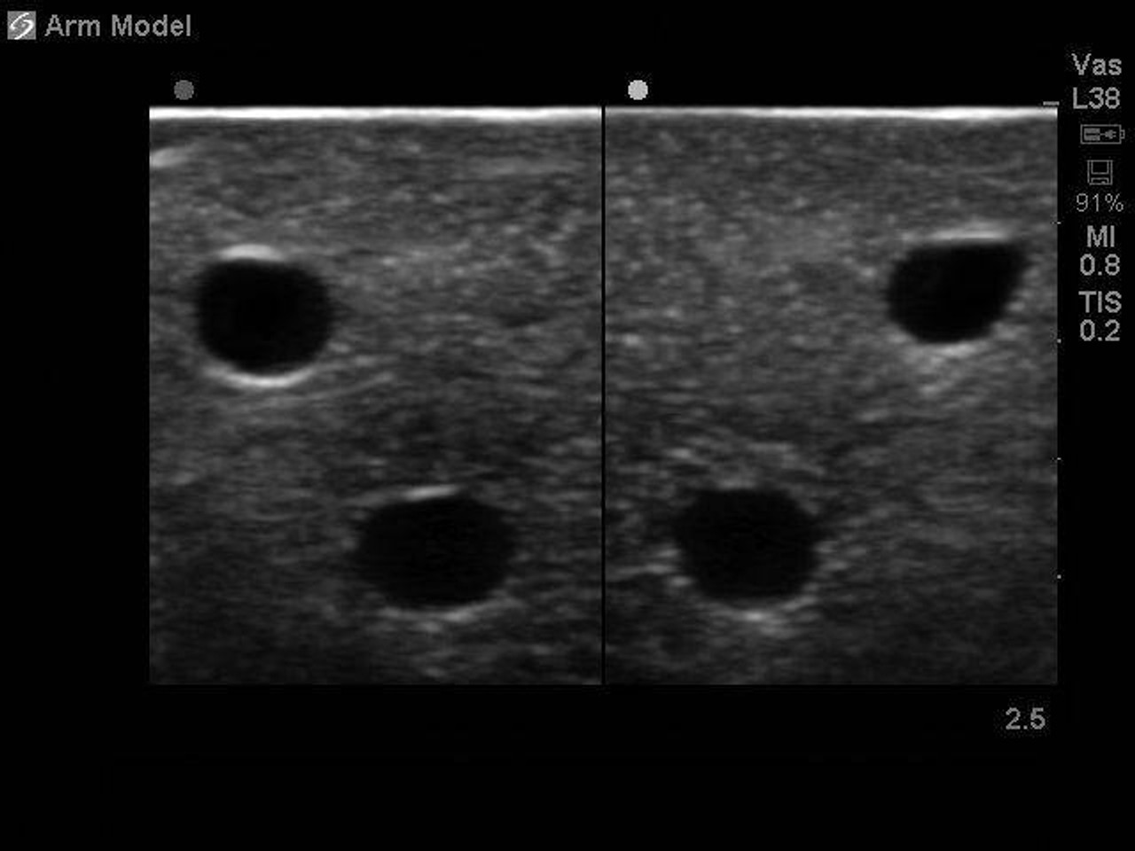 blood clot in arm ultrasound