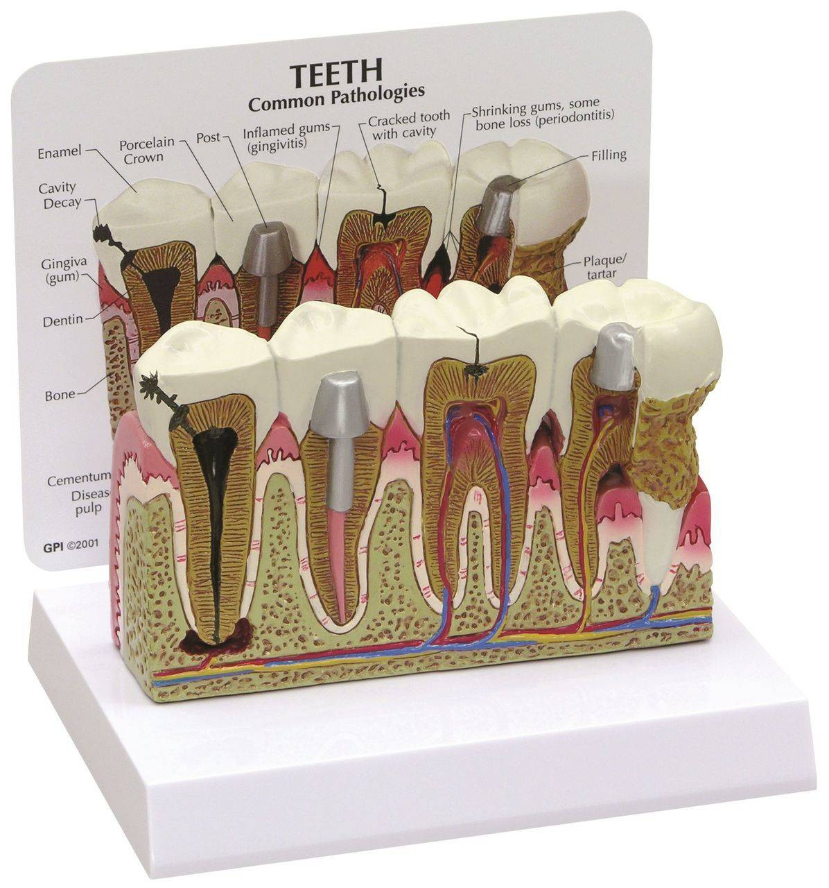 and　Diseased　Anatomy　Teeth　Model　Gums