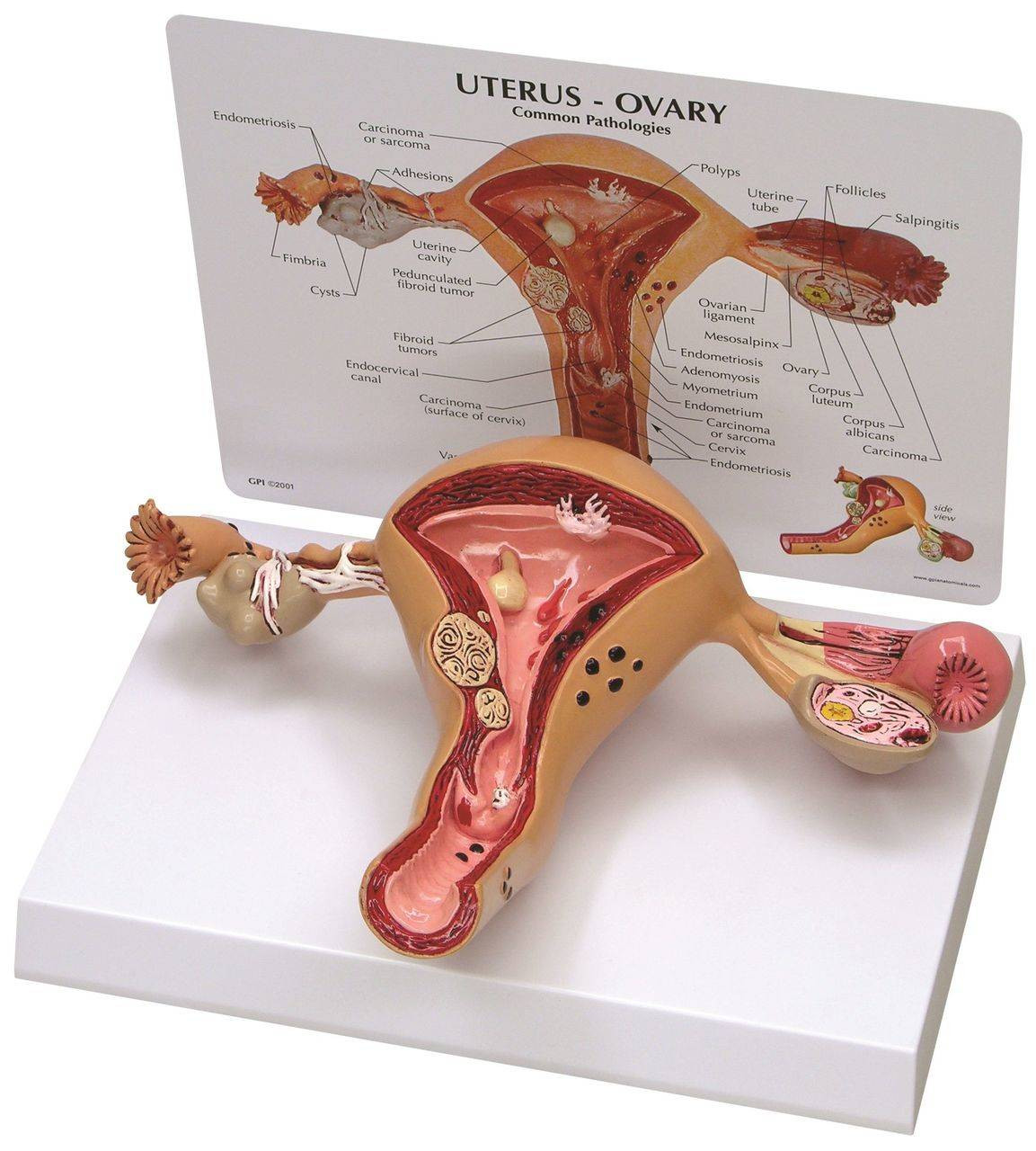 Female Reproductive System Model Ovaries   Gpi Anatomicals Uterus And Ovary Anatomy Model With Pathologies  78241.1603827423 