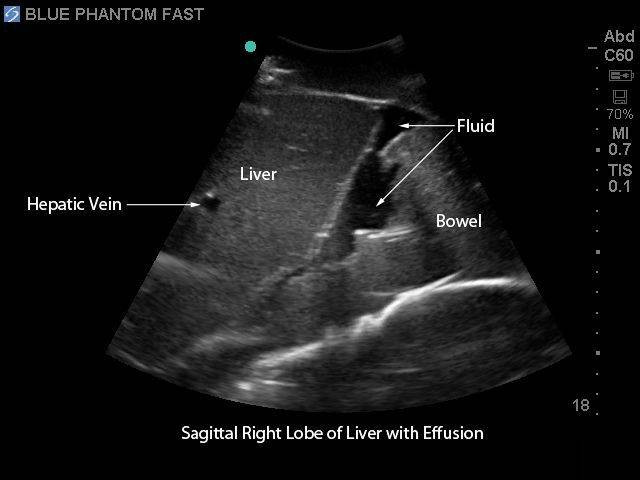 FAST Exam Real Time Ultrasound Training Model