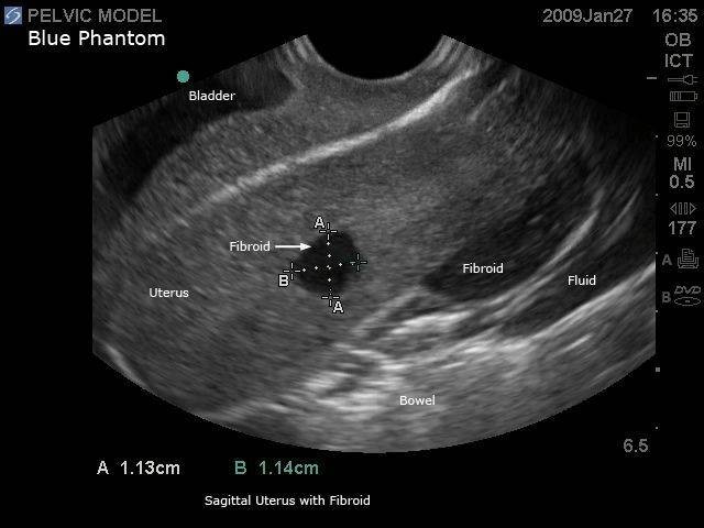 General Pathology Transvaginal Ultrasound Training Model General Pathology Transvaginal Ultrasound Training Model