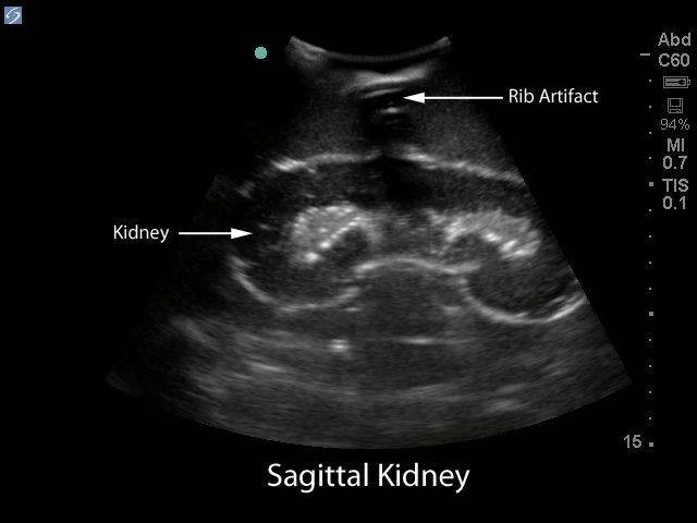 Renal Biopsy Ultrasound Training Model