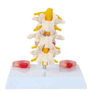 Axis Scientific Lumbar Vertebrae with Prolapsed Discs