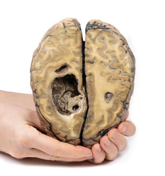 3D Printed Metastatic Carcinoma in the Brain 1