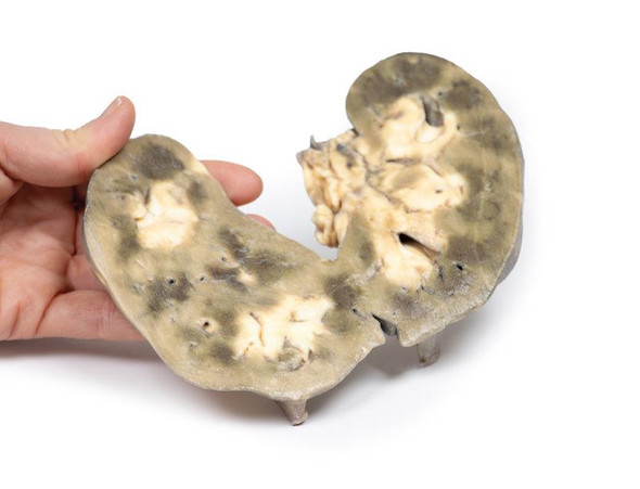 3D Printed Horseshoe Kidney 1