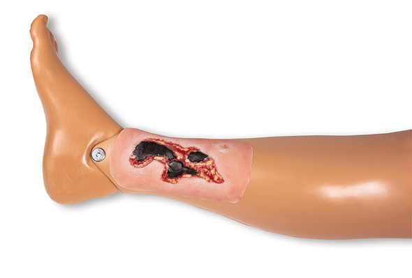 Wound Moulage Arterial Leg Ulcer, Small, Exudation Phase 1
