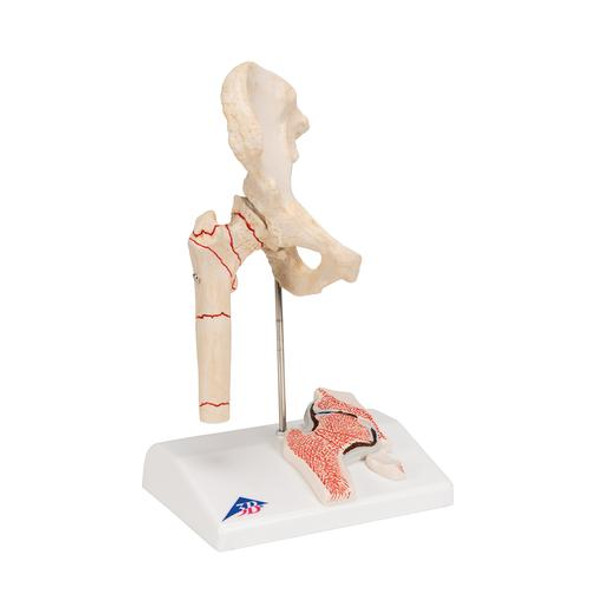 Femoral Fracture Anatomy Model - Right Side View 1
