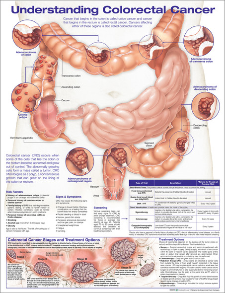 Understanding Colorectal Cancer Laminated Anatomical Chart, 2nd Edition