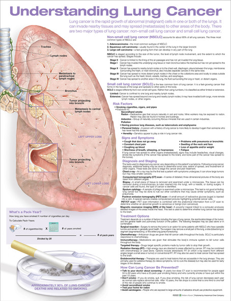 Understanding Lung Cancer Laminated Anatomical Chart, 2nd Edition