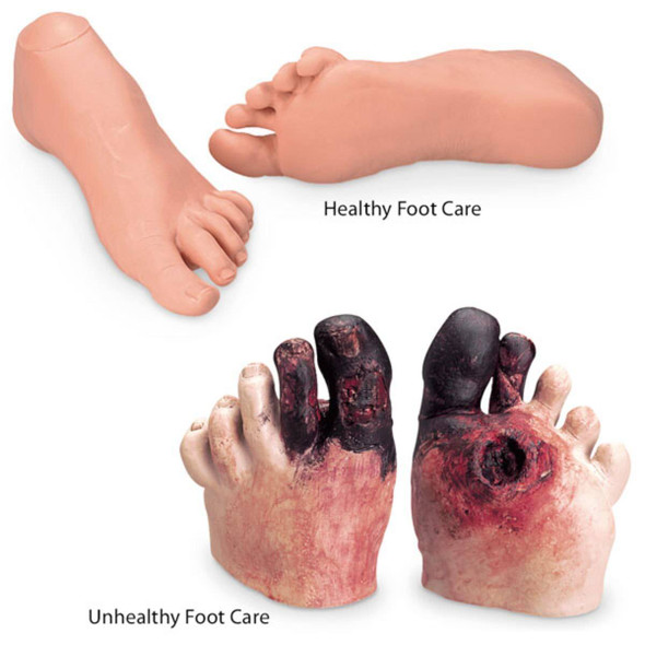 Nasco Healthy and Unhealthy Foot Care Set