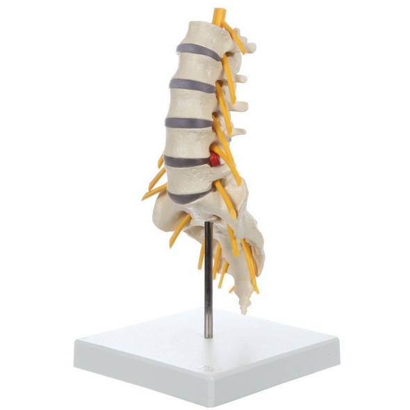 Rudiger Anatomie Premium Lumbar Spine with Herniated Disc 1