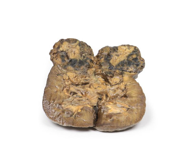 3D Printed Renal Cell Carcinoma