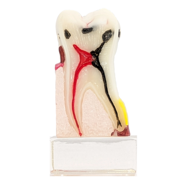 Axis Scientific Dental Model with Tooth Decay Scale, Enlarged 4 Times Life Size