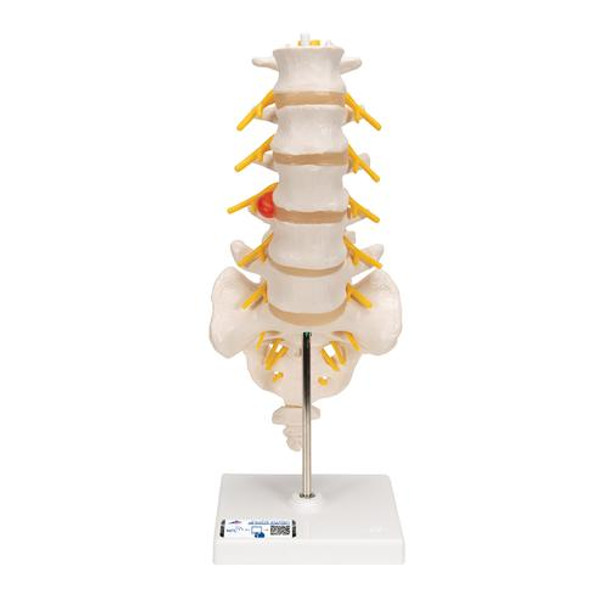 Lumbar Spinal Column Anatomy Model With Dorso-Lateral Prolapsed Intervertebral Disc