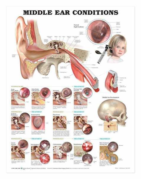 Middle Ear Conditions Laminated Anatomical Chart - 2nd Edition
