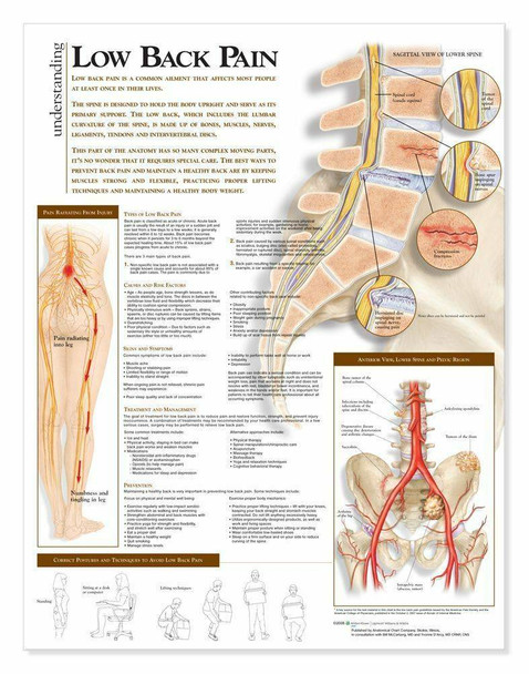 Understanding Low Back Pain Laminated Anatomical Chart