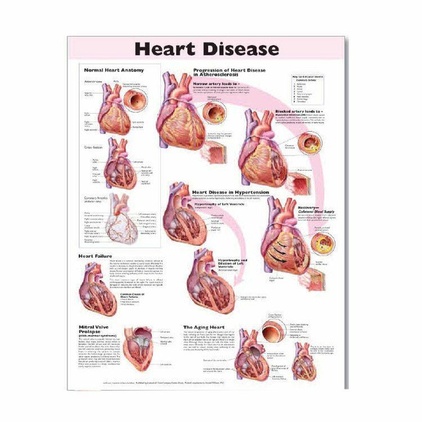 Heart Disease Laminated Anatomical Chart - 2nd Edition