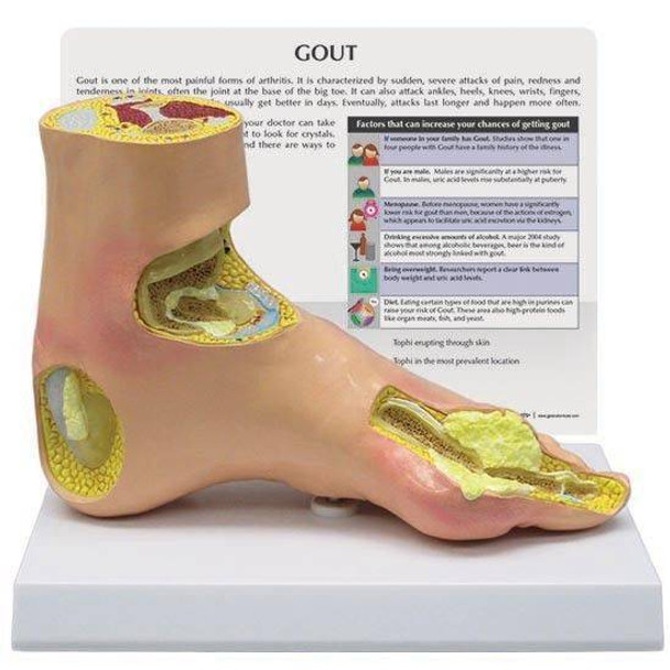 Foot with Gout Anatomy Model