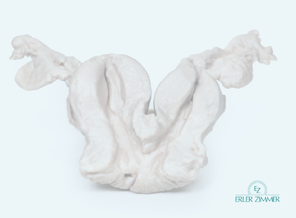 Anatomical model of a uterus on a white background.