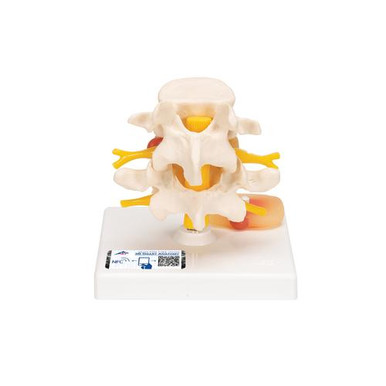 3B Scientific Lumbar Spinal Column Anatomy Model With Prolapsed