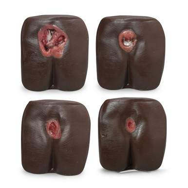 Nasco Healthcare Pressure Ulcer/Bedsore Model - Dark