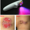 LASPOT New Red Cold Laser Acupuncture Combine Blue Light And Yellow Light Therapy Pain Relief Device Sciatica Laser Therapeutic