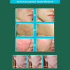 Face Anti Acne Cream Blackhead Removal Cream Cleaning Pimple Quickly Anti Acne Whelk Treatment Scars Repairing Cream