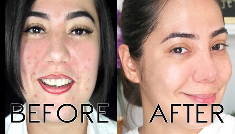 the ordinary zinc acne