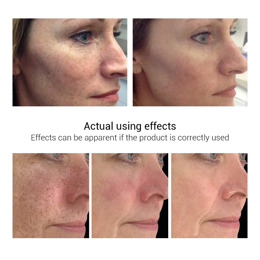 vitamin c for dark spots