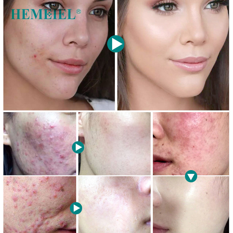 pimple pores removal cream