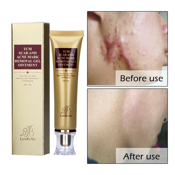 OMY LADY LANBENA Acne Scar Removal Cream Skin Repair Face Cream Acne Spots Acne Blackhead Whitening Cream Stretch Mark Treatment