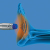 enPuls 2.0 radial pulse shockwave handpiece positioned at the plantar region of the foot in a professional clinical setting.