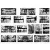 Dental X-Rays