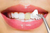 Porcelain Veneers in West Bloomfield, Ann Arbor & Waterford, MI - Dental House Dentist Office