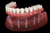 Implant-Supported Dentures in  Woodhaven Downriver, West Bloomfield, Ann Arbor & Waterford, MI - Dental House Dentist Office