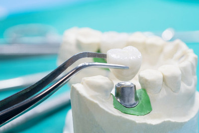 Single-Tooth Implants in Woodhaven Downriver, West Bloomfield, Ann Arbor & Waterford, MI - Dental House Dentist Office