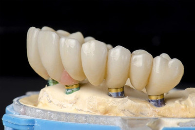 Implant-Retained Bridges in Downriver, West Bloomfield, Ann Arbor & Waterford, MI - Dental House Dentist Office