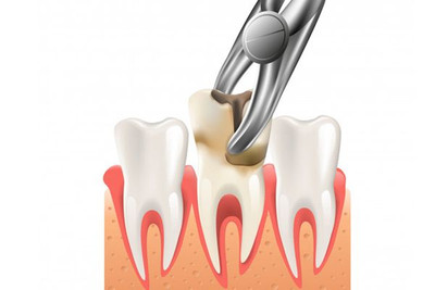 Teeth Extraction (Simple and Surgical) in West Bloomfield, Ann Arbor & Waterford, MI - Dental House Dentist Office