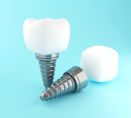 Dental Implants: Rediscover Your Smile and Confidence with Dental House MI Dental Implants: Rediscover Your Smile and Confidence with Dental House MI