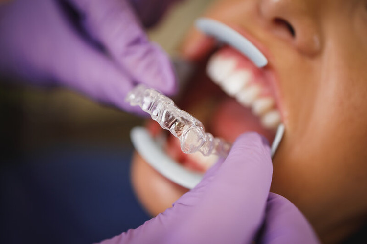 Invisalign for Teens: A Game-Changer in Adolescent Orthodontic Treatment