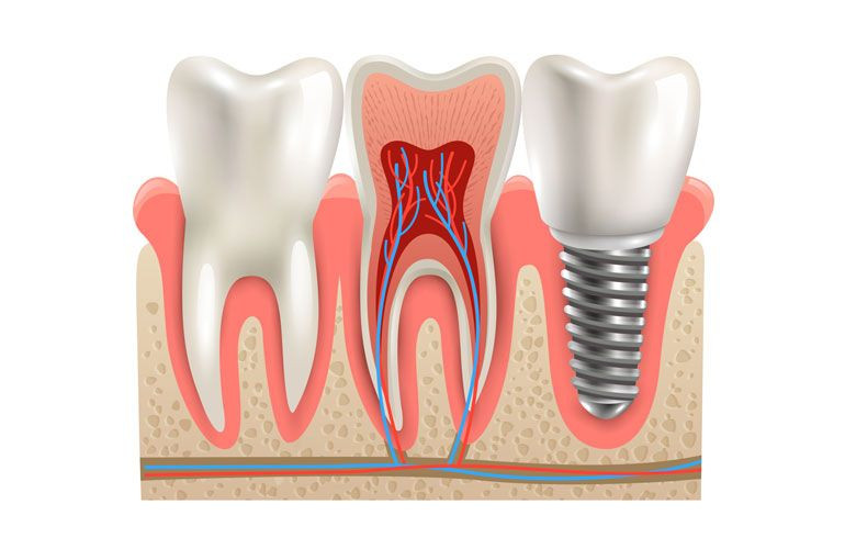 What is a Dental Implant? What is a Dental Implant?