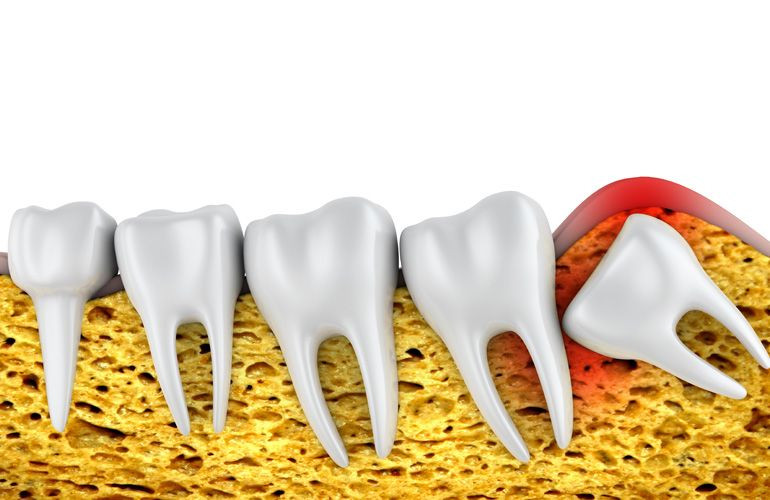 What to Expect When Your Wisdom Teeth Ages - Dental Health 101 What to Expect When Your Wisdom Teeth Ages - Dental Health 101